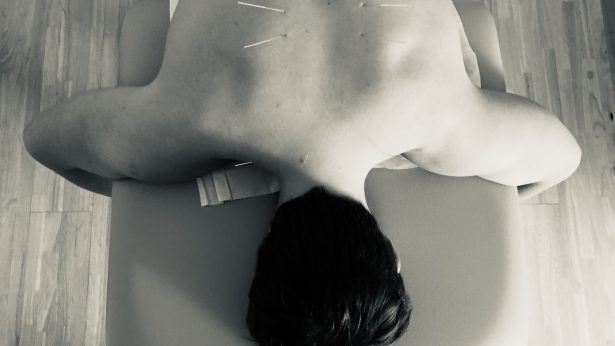 Acupuncture Needles on Back